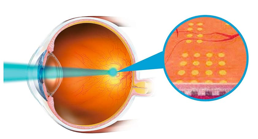 パスカルレーザー