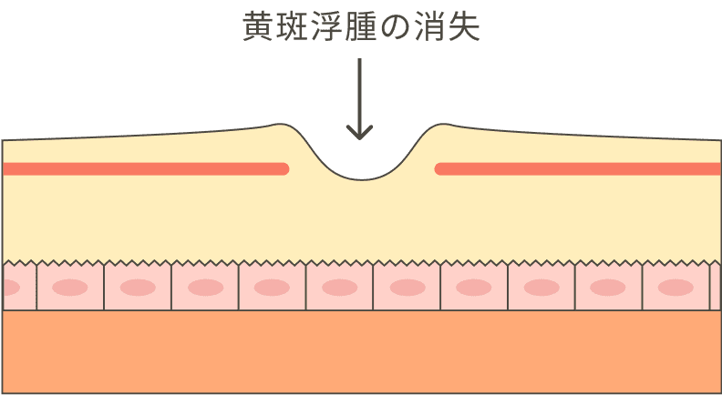 黄斑浮腫の消失
