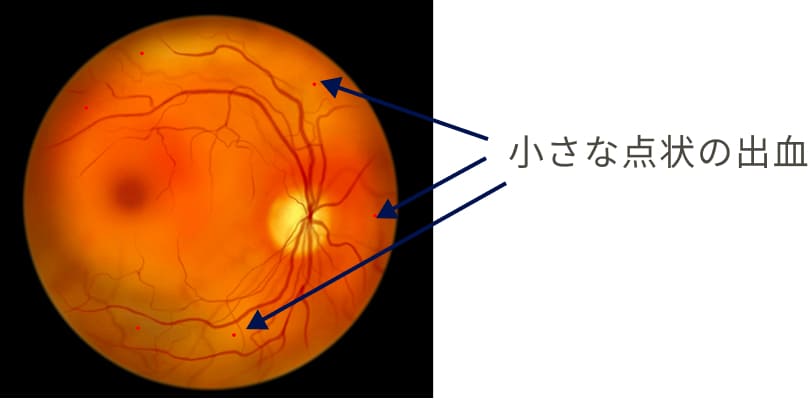 小さな点状の出血