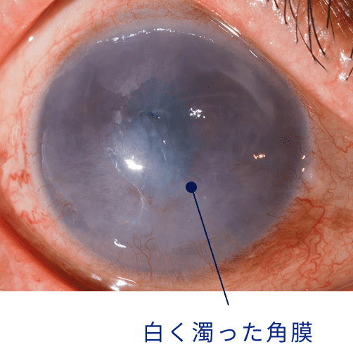 白く濁った角膜