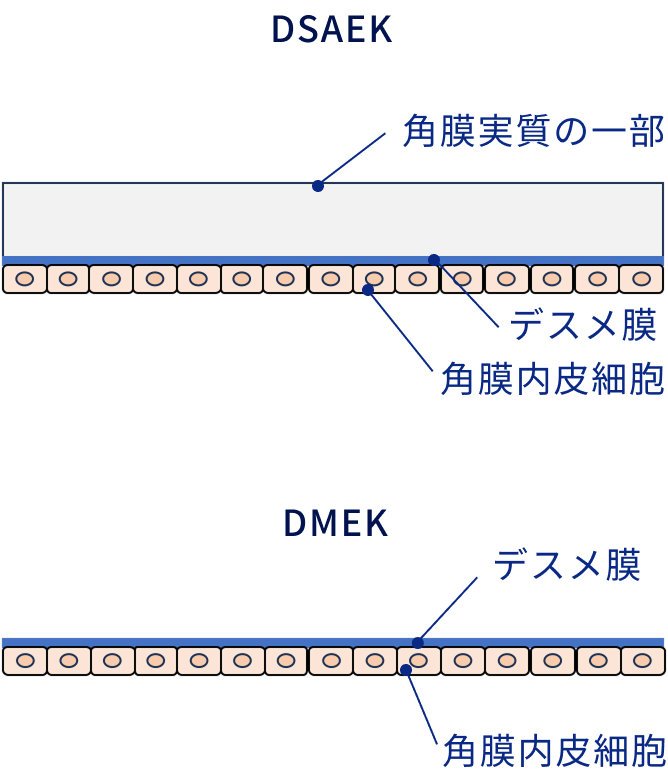 DSAEK・DMEKについて