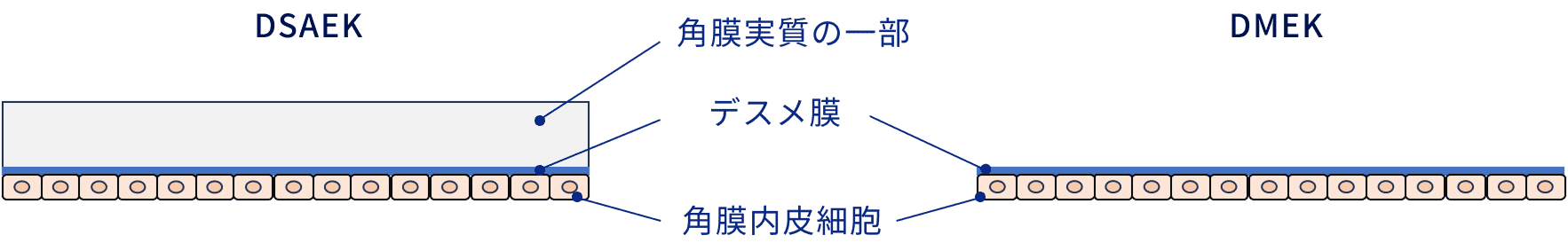 DSAEK・DMEKについて