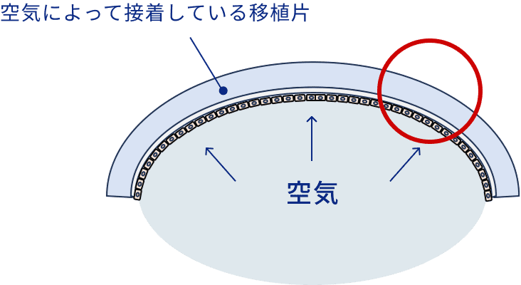 空気によって接着している移植片