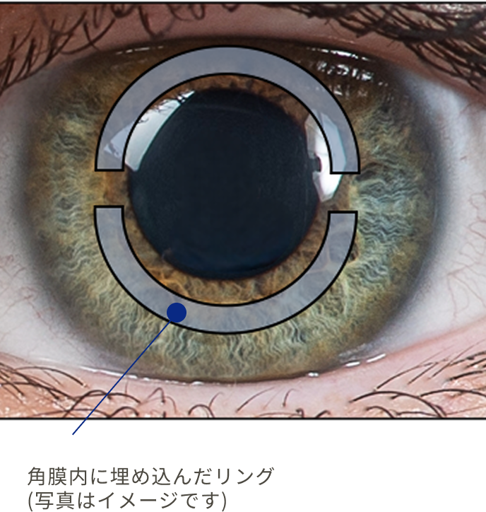 角膜内に埋め込んだリング
