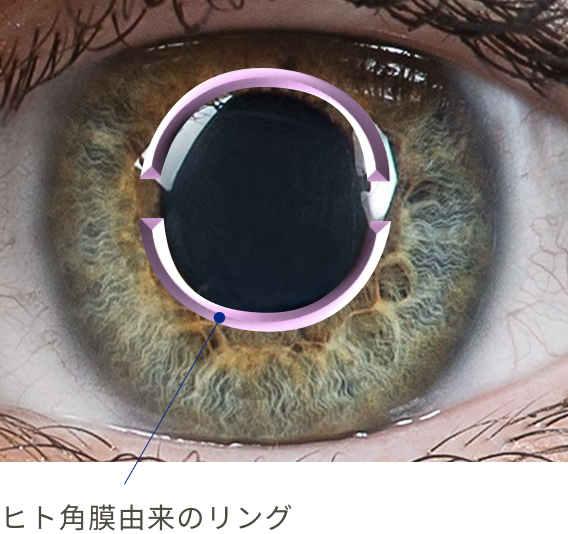 ヒト角膜由来のリング
