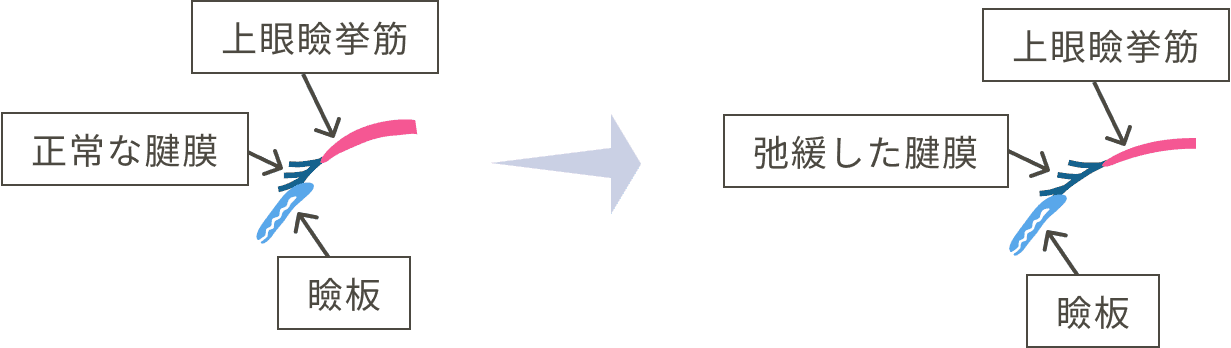 腱膜性眼瞼下垂
