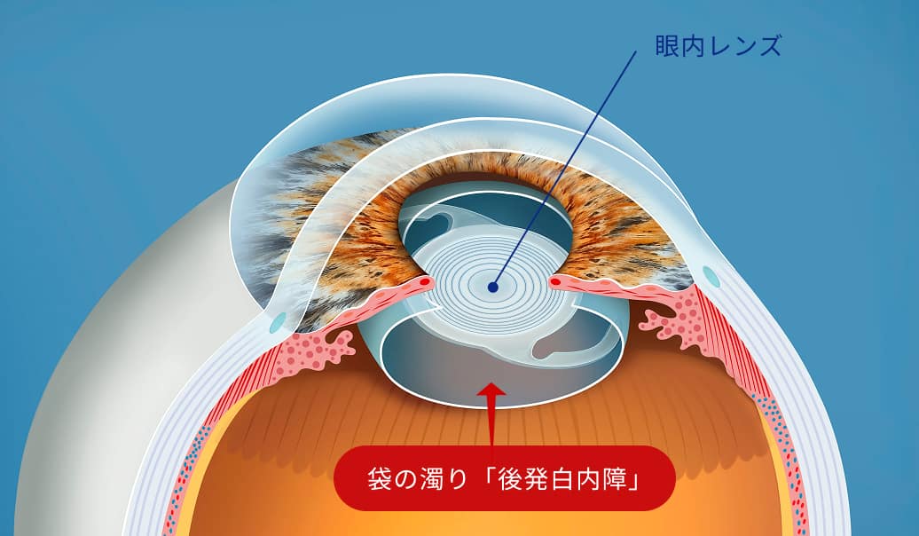袋の濁り「後発白内障」