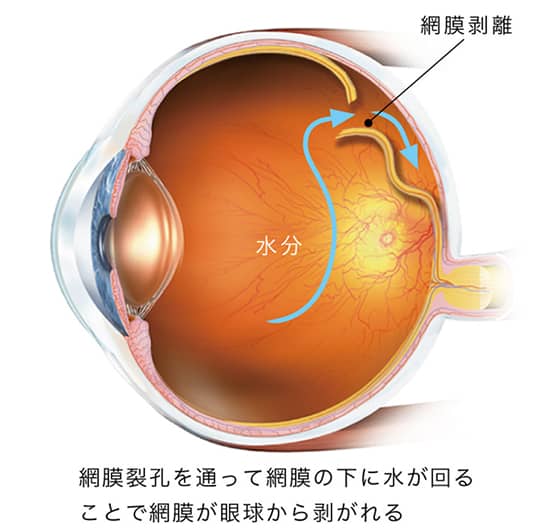 網膜裂孔を通って網膜の下に水が回ることで網膜が眼球から剥がれる