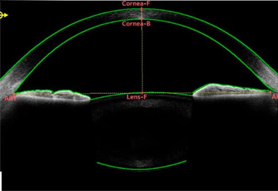 前眼部光干渉断層撮影装置 CASIA2