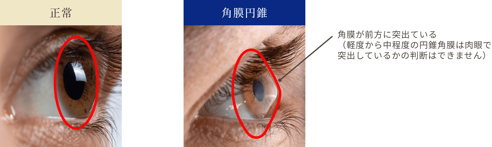 角膜が前方に突出している