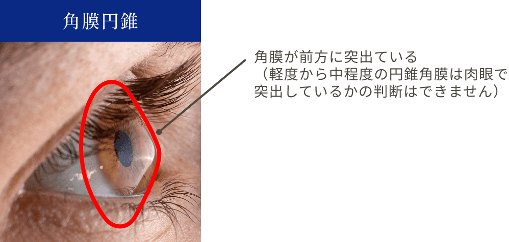 角膜が前方に突出している