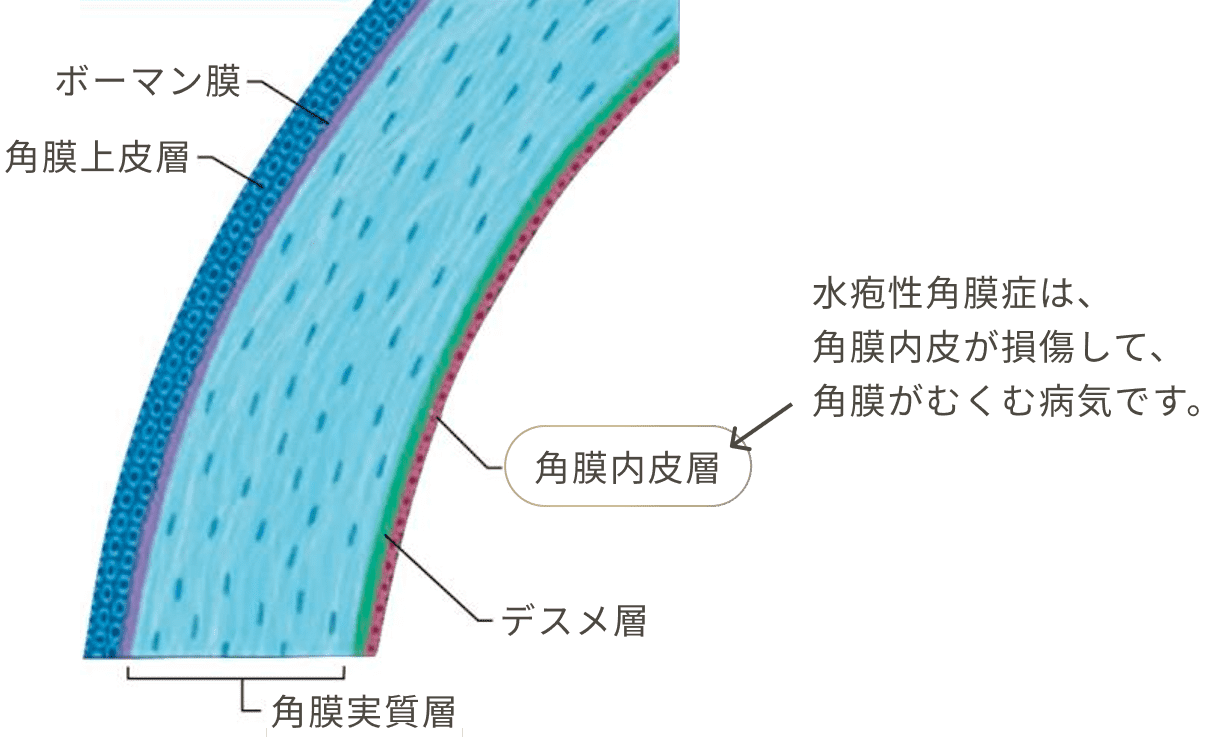 水疱角膜症は、角膜内皮が損傷して角膜がむくむ病気です。
