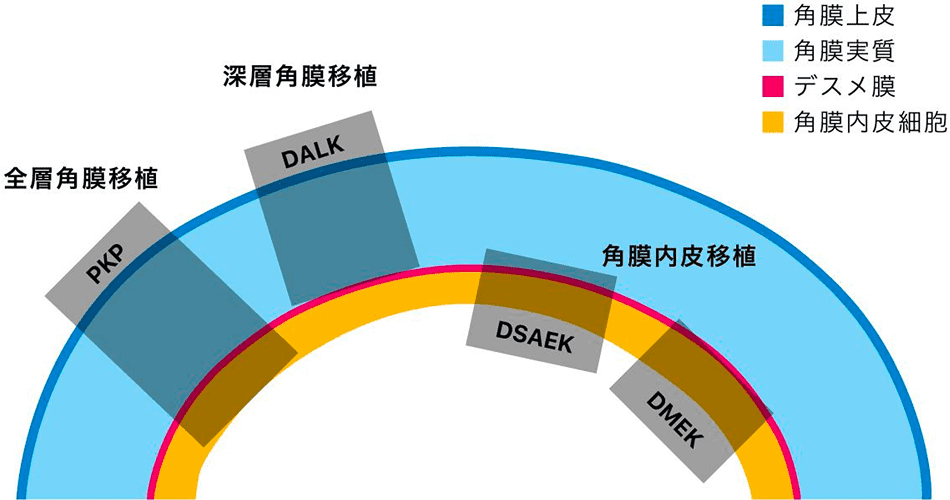 角膜移植の種類