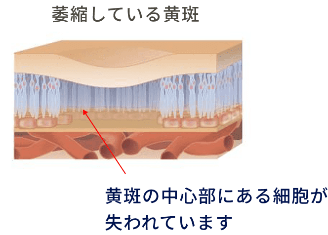 萎縮している黄斑 (黄斑の中心部にある細胞が失われています) 