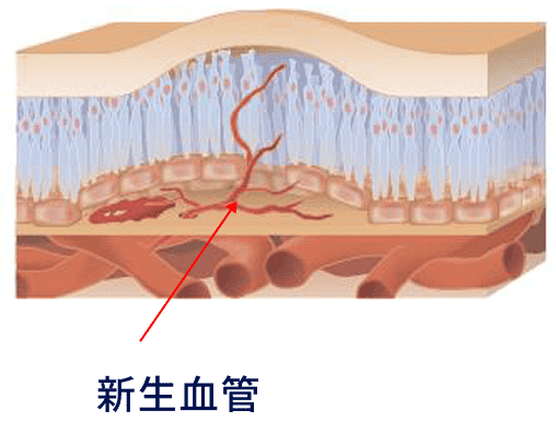 新生血管