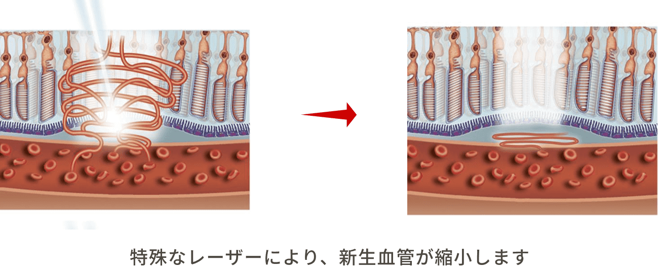 特殊なレーザーにより、新生血管が縮小します。