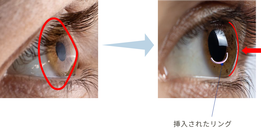 挿入されたリング