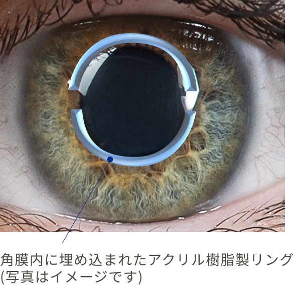 角膜内に埋め込まれたアクリル樹脂製リング