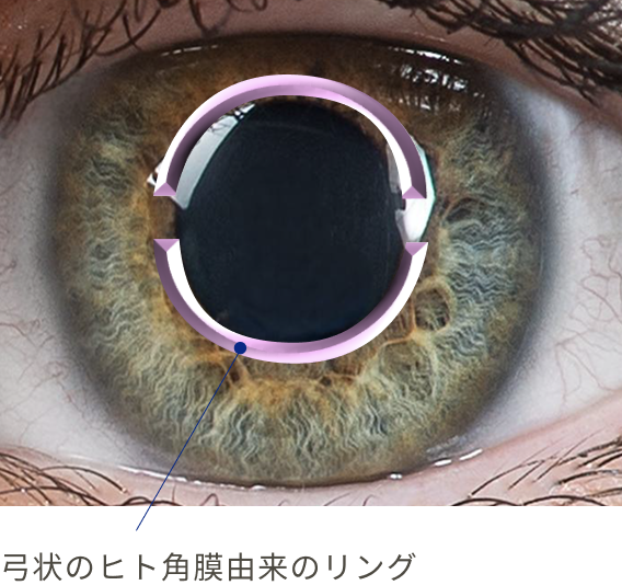 弓状のヒト角膜由来のリング