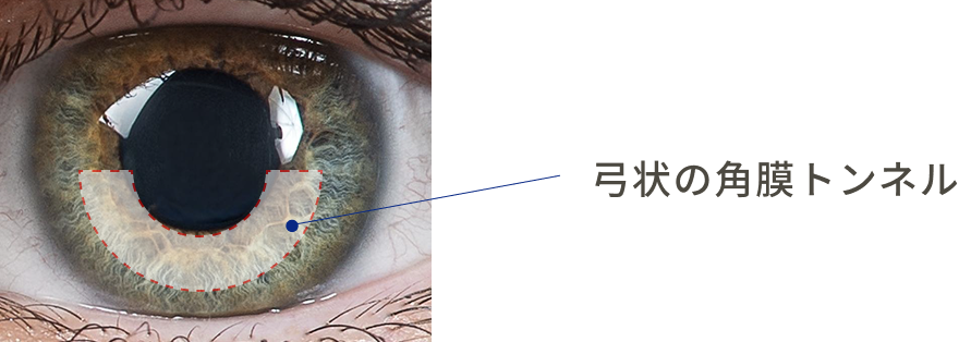 弓状の角膜トンネル