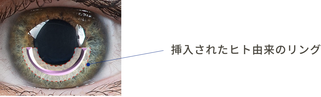 挿入されたヒト由来のリング