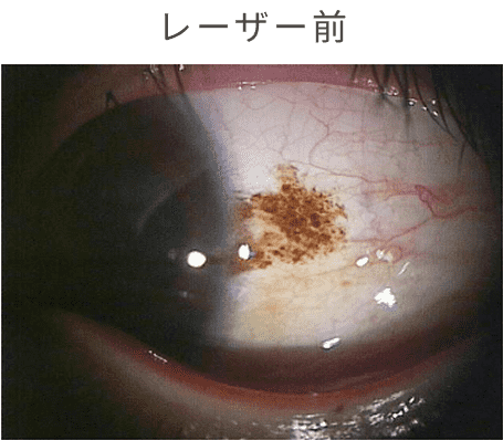 レーザー前