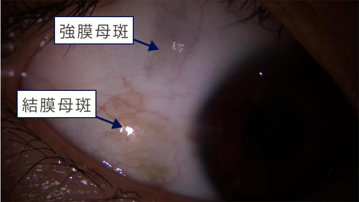 結膜母斑と強膜母斑