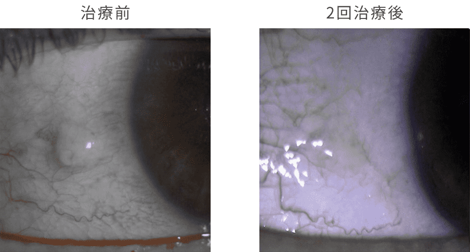 エキシマレーザー治療