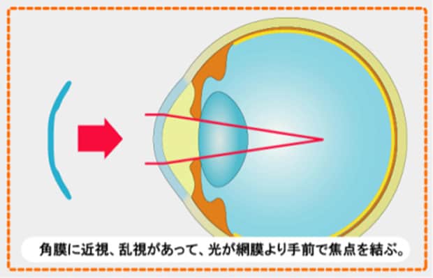 角膜に近視、乱視があって、光が網膜より手前で焦点を結ぶ。