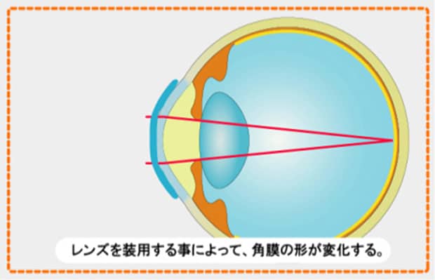 レンズを装着することによって、角膜の形が変形する。