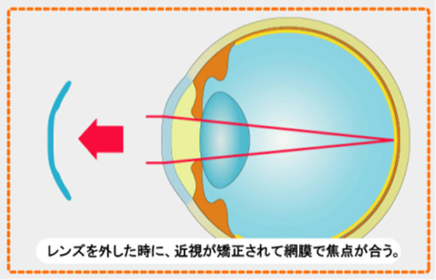 レンズを外したときに、近視が矯正されて網膜で焦点があう。