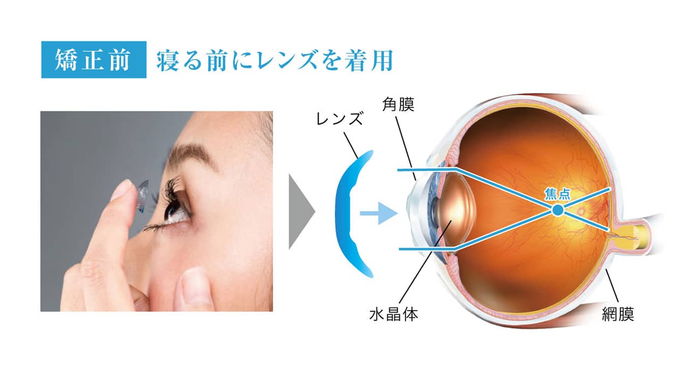 （矯正前）寝る前にレンズを着用"