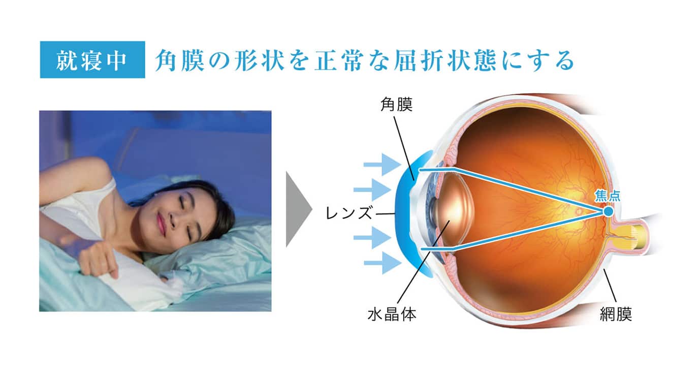 （就寝中）角膜の形状を正常な屈折状態にする"
