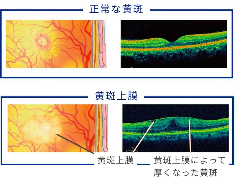 黄斑上膜