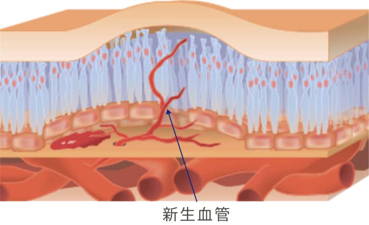 新生血管