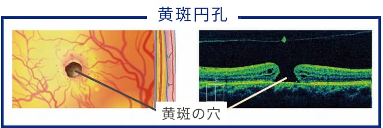 黄斑円孔