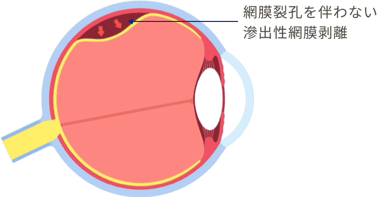 網膜裂孔を伴わない滲出性網膜剥離