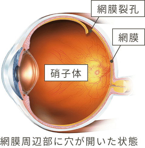 網膜周辺部に穴が開いた状態