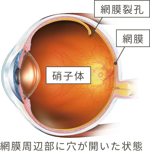 網膜周辺部に穴が開いた状態