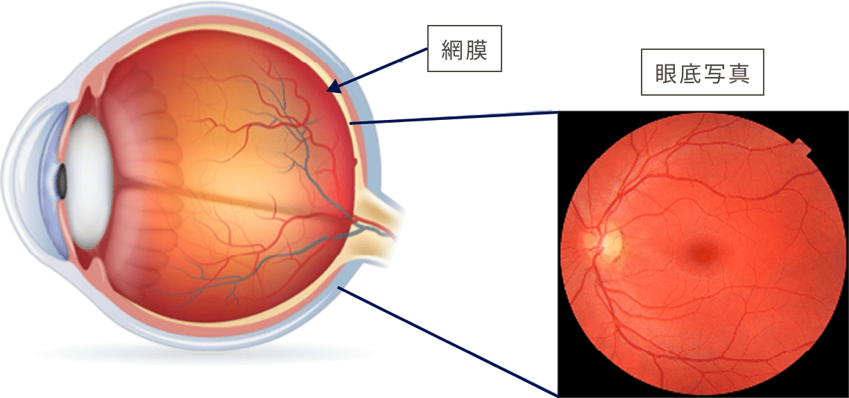 眼底写真