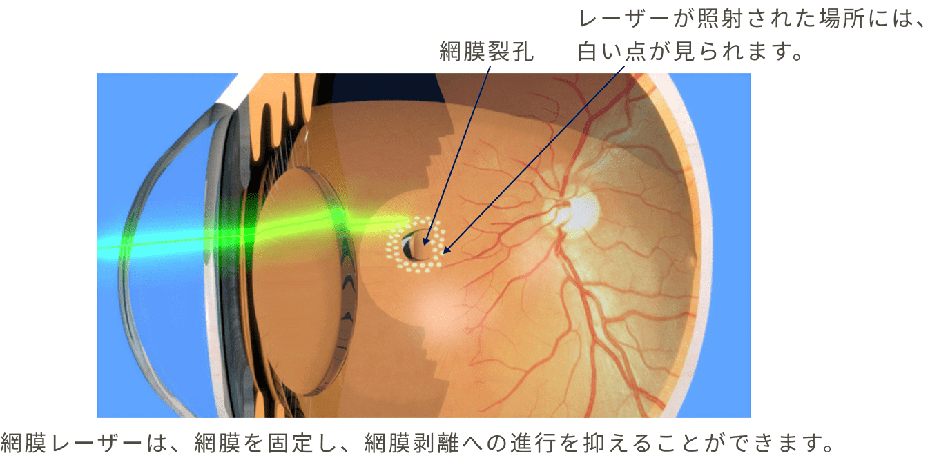 網膜レーザーは、網膜を固定し網膜剥離への進行を抑えることができます
							