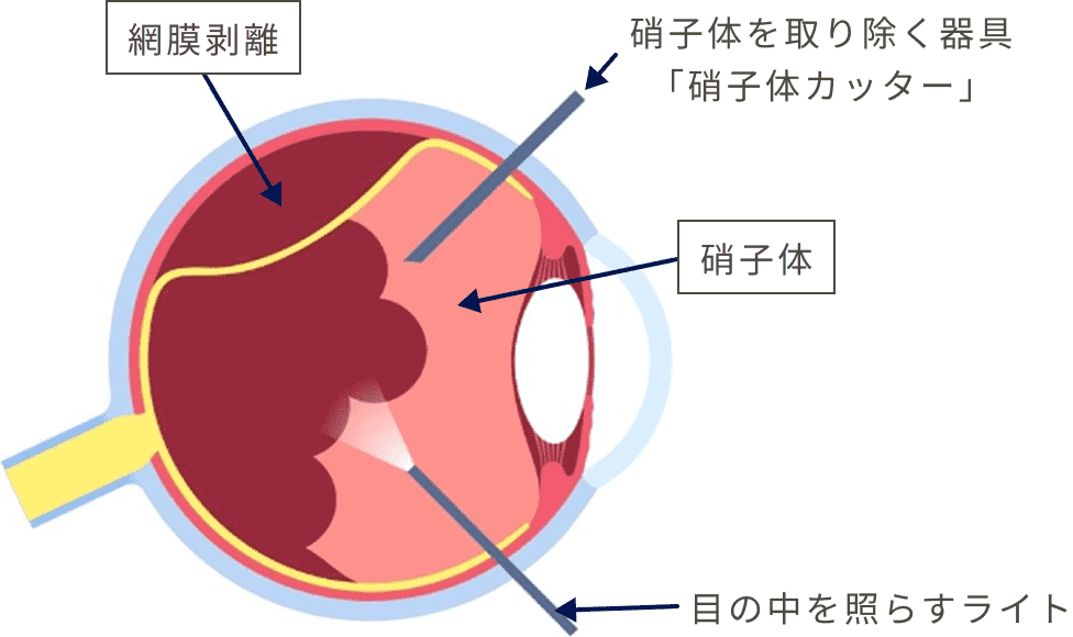 硝子体を取り除く