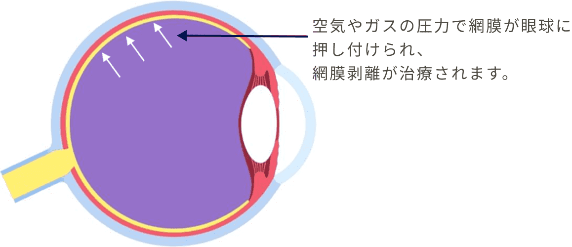 空気やガスの圧力で網膜が眼球に押し付けられ、網膜剥離が治療される
