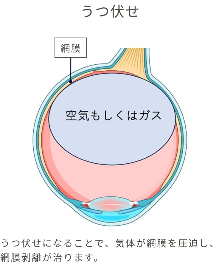 うつ伏せになることで、気体が網膜を圧迫し、網膜剥離が治ります。
