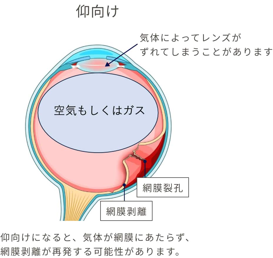 仰向けになると、気体が網膜にあたらず、網膜剥離が再発する可能性があります。