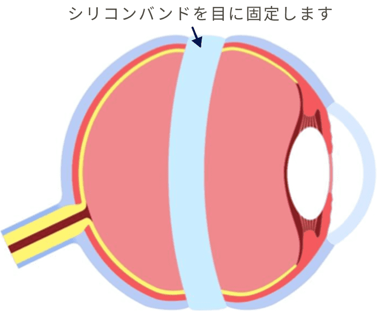 シリコンバンドを目に固定します