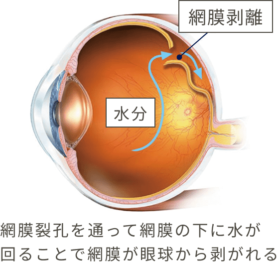 網膜裂孔を通って網膜の下に水が回ることで網膜が眼球からはがれる