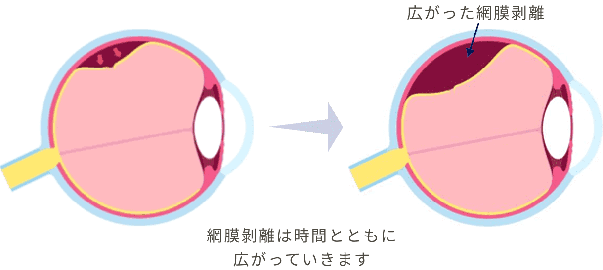 網膜剥離は時間とともに広がっていきます