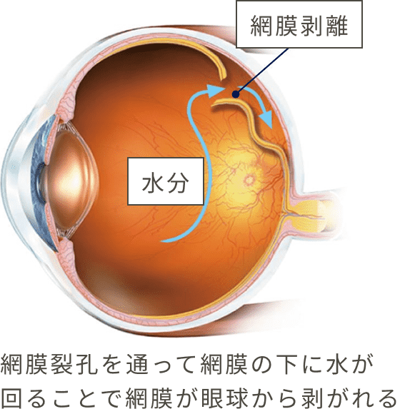 網膜裂孔を通って網膜の下に水が回ることで網膜が眼球から剥がれる