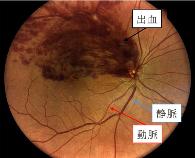 網膜静脈閉塞症